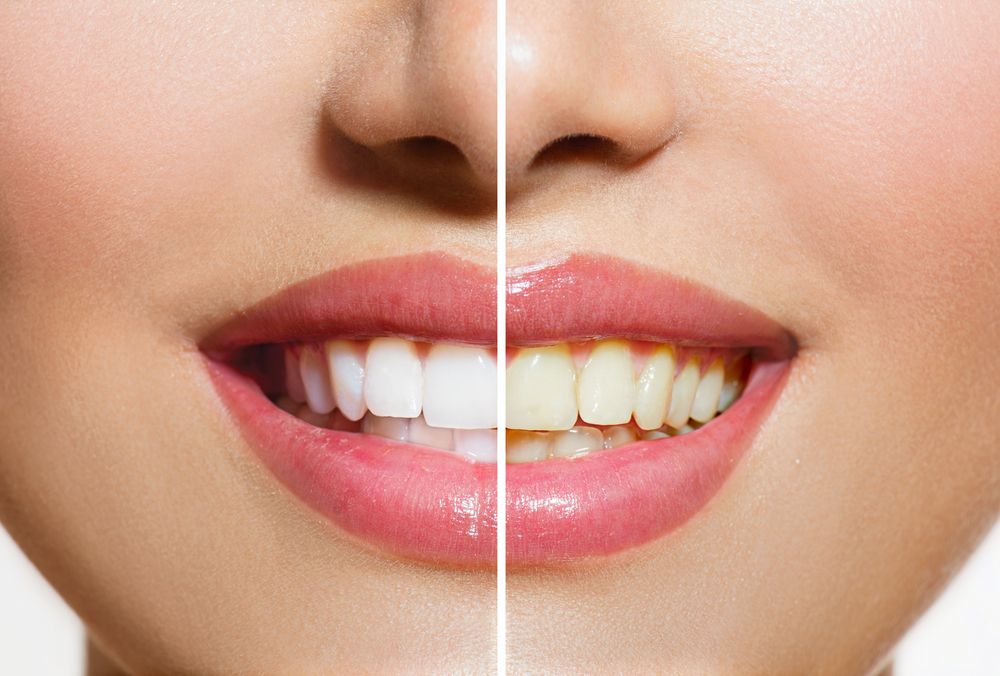 Why Do Teeth Turn Yellow?